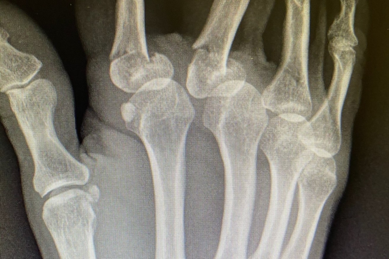 Queensland Attorney-General Yvette D'Ath shared an x-ray of her broken and dislocated fingers on social media. (Photo: Twitter)