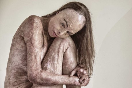 How this haunting portrait of a Queensland burns survivor won worldwide acclaim