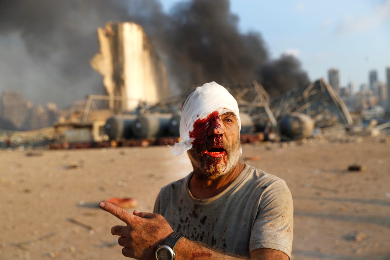 An injured man walks at the explosion scene that hit the seaport, in Beirut, Lebanon. (Photo: AP Photo/Hussein Malla)