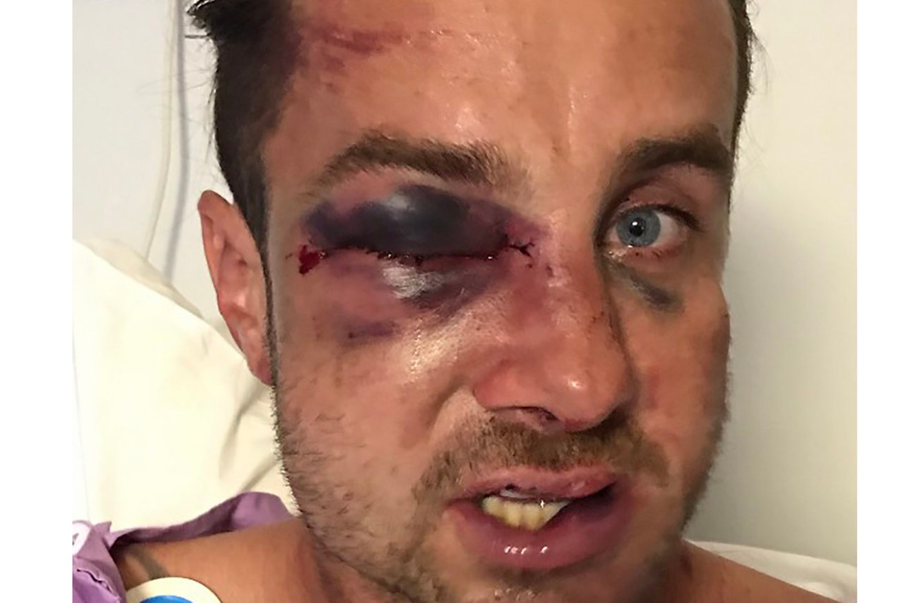 A supplied image shows 35-year-old Josh Jones at the Royal Brisbane and Women’s Hospital after sustaining serious facial injuries. Three men will face court over a brawl at a Queensland sports ground. (AAP Image/Supplied by Ricky Jones) 