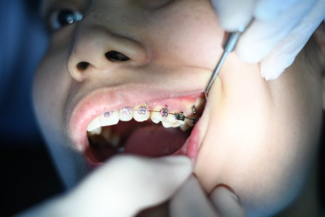 Chalky teeth linked to childhood illness