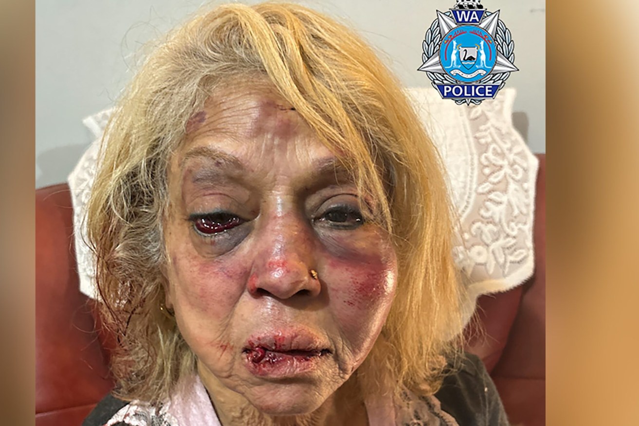 ***GRAPHIC CONTENT WARNING*** A supplied image obtained on Tuesday, April 30, 2024, of Ninette Simmons was injured during a robbery at her Perth home. (AAP Image/Supplied by WA POLICE) 